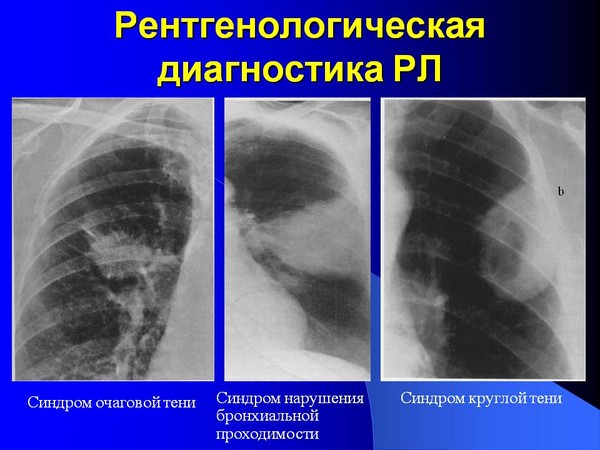 Московский рентген на дому, Рентген на дому Москва, Флюорография на дом Москва, Цифровой рентген на дому Москва, Травматолог на дом Москва, ЛОР на дом Москва , Стоматолог на дом, Нарколог на дом Москва, Психолог на дом, Невролог на дом, УЗИ на дому Москва, ЭКГ на дому Москва, Анализы на дому Москва, бесплатно по полису ДМС добровольное медицинское страхование. 
Балканская рамка - ( аренда и продажа) ; 
#рентгеннадому #рентгеннадомуМосква 
Если за кустами крыжовника будет правильный уход, то вы сможете наслаждаться вкусом его ягод очень длительное время, ведь крыжовник способен расти и плодоносить на одном месте 25-30 лет. Выбрав для крыжовника правильное место для посадки, теперь узнаем, какой уход ему нужен. 
Крыжовник не любит загущенности. 
Даже, если куст будет расти на солнечном месте, но вы не станете его прореживать хотя бы раз в год, урожая соберете мало. Понимаю, что колючки крыжовника не всем по нраву, но если хотите увидеть побольше ягод, то придется запастись специальными рукавицами и одеждой, а также секатором на длинной ручке. 
Рекомендуется делать обрезку крыжовника два раза в год: весной и после сбора урожая. Если у вас на это нет времени, то сделайте, хотя бы одну, но предпочтение отдайте осенне-летней обрезке. Вырезайте старые, больные, поломанные; удалите лежащие на земле или переплетающиеся и тонкие; подрежьте верхушки на оставшихся побегах до первой веточки, растущей наружу. Весной можно просто удалить поломанные и вымерзшие побеги, оставив на кусте не менее 5-7 побегов. Замечено, что если середина крыжовника хорошо прорежена, то и ягод на нем намного больше. 
Полив крыжовника 
Московский рентген на дому, Рентген на дому Москва, Флюорография на дом Москва, Цифровой рентген на дому Москва, Травматолог на дом Москва, ЛОР на дом Москва , Стоматолог на дом, Нарколог на дом Москва, Психолог на дом, Невролог на дом, УЗИ на дому Москва, ЭКГ на дому Москва, Анализы на дому Москва, бесплатно по полису ДМС добровольное медицинское страхование. 
Балканская рамка - ( аренда и продажа) ; 
#рентгеннадому #рентгеннадомуМосква 
Нельзя поливать крыжовник прямо под куст, чтобы не размыть место залегания корневой шейки. Корни крыжовника в основном уходят вниз и мало распространены в стороны, поэтому для полива делают выемки по периметру куста или копают канавку вокруг и поливают в них. Расход воды зависит от возраста растений: молодым — хватит по 8-10 л на куст, а взрослым большим кустам— не менее 15 л, а в период созревания ягод — 25 — 30 л. 
Прищипка однолетних побегов в конце лета. 
Этот простой прием поможет увеличить вам урожай, да и ягоды будут намного крупнее. После сбора урожая (июль-август) прищипните все однолетние приросты, отступив сверху до 8 см и подрезав секатором до почки, растущей вбок или наружу. 
Подкормка крыжовника 
В первые два года посадки подкармливала крыжовник минеральными удобрениями, о них подробно рассказывала в статье Как правильно выбрать минеральные удобрения. Но теперь кусты полностью на "естественном питании" 
Не перекармливайте крыжовник. Частенько нам кажется, что мы не докормили свои растения и стараемся их снова и снова удобрить. Но я с крыжовником поступаю иначе: вношу подкормку только два раза за год. Осенью перед зимовкой — основное внесение — под куст закапываю ведро компоста (либо разведенные с торфом фекалии), окучиваю торфом, а весной пару раз поливаю мочевиной и рассыпаю по 2 стакана золы под куст. 
Обработка от вредителей и болезней 
Обработку от вредителей делаю редко. Например, в прошлом году пришлось пару раз обрабатывать препаратом Фуфанон — до и после цветения. Но в этом году обошлась "без химии", только несколько раз до появления плодов опудривала кусты смесью золы и мелкой табачной пыли. 
От болезней я обрабатываю осенью и весной весь сад и заодно кусты крыжовника бордоской смесью. Еще бывает, когда есть время, применяю метод ошпаривания кустов; делаю это до распускания почек, рано весной. 
Омоложение крыжовника 
Если крыжовник достаточно давно обосновался на вашем участке, то может случится, что его ягоды станут мельчать или их становится меньше - это сигнал: омолодите кустик. Обычно, это случается на 6-ом, 7-ом году роста. Омолодить можно либо разделением, либо кардинальной обрезкой куста. Вырезайте ветки до самого основания, не оставляя пеньков, сохранив не более 3-4 сильных и здоровых. Обновленный кустик снова будет давать качественный урожай. 
Московский рентген на дому, Рентген на дому Москва, Флюорография на дом Москва, Цифровой рентген на дому Москва, Травматолог на дом Москва, ЛОР на дом Москва , Стоматолог на дом, Нарколог на дом Москва, Психолог на дом, Невролог на дом, УЗИ на дому Москва, ЭКГ на дому Москва, Анализы на дому Москва, бесплатно по полису ДМС добровольное медицинское страхование. 
Балканская рамка - ( аренда и продажа) ; 
#рентгеннадому #рентгеннадомуМосква 
Крыжовник в первые пару лет может расти не так быстро, как некоторые другие ягодные или декоративные кустарники, но это вполне нормально. Обеспечьте правильный уход за кр ...